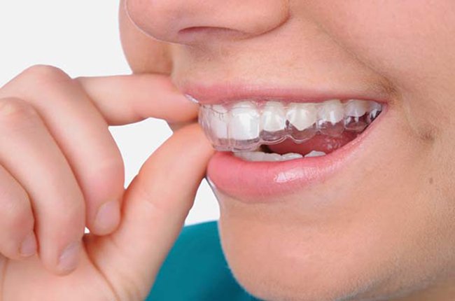 Các loại niềng răng cho trẻ em
